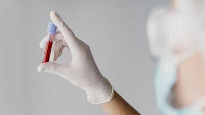 Exame de sangue inovador promete revolucionar o diagnóstico do câncer colorretal